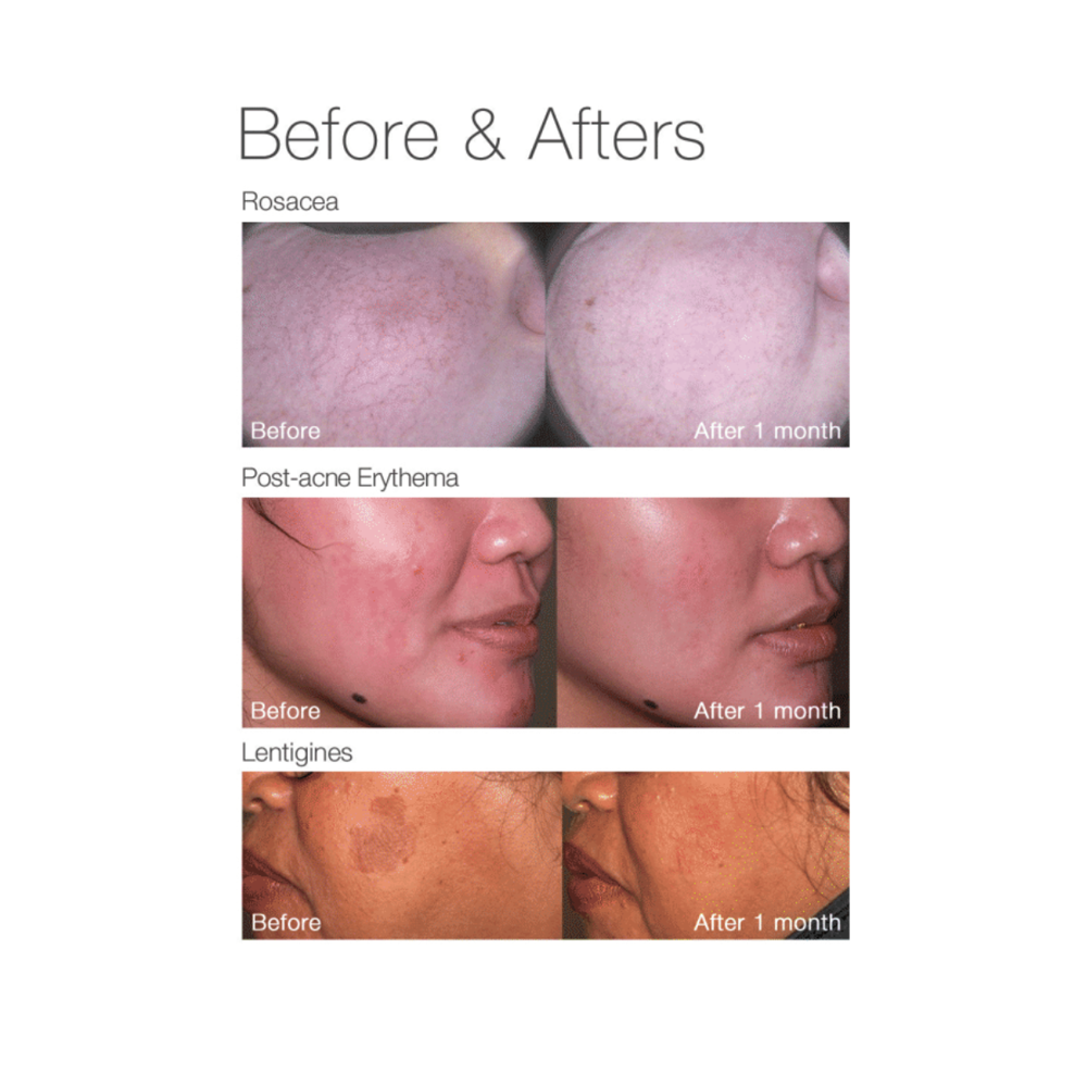 Yellow Laser Full-Face Scan — Buy One, Get One (2 Treatments)