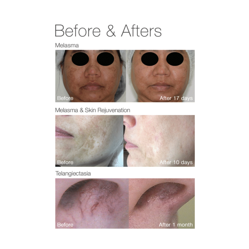 Yellow Laser Full-Face Scan — Buy One, Get One (2 Treatments)
