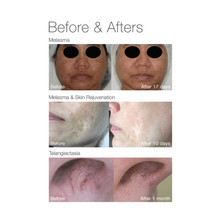 Load image into Gallery viewer, Pigmentation, Rosacea, Melasma, Broken Capillaries treatment = Full Face Laser Rejuvenation
