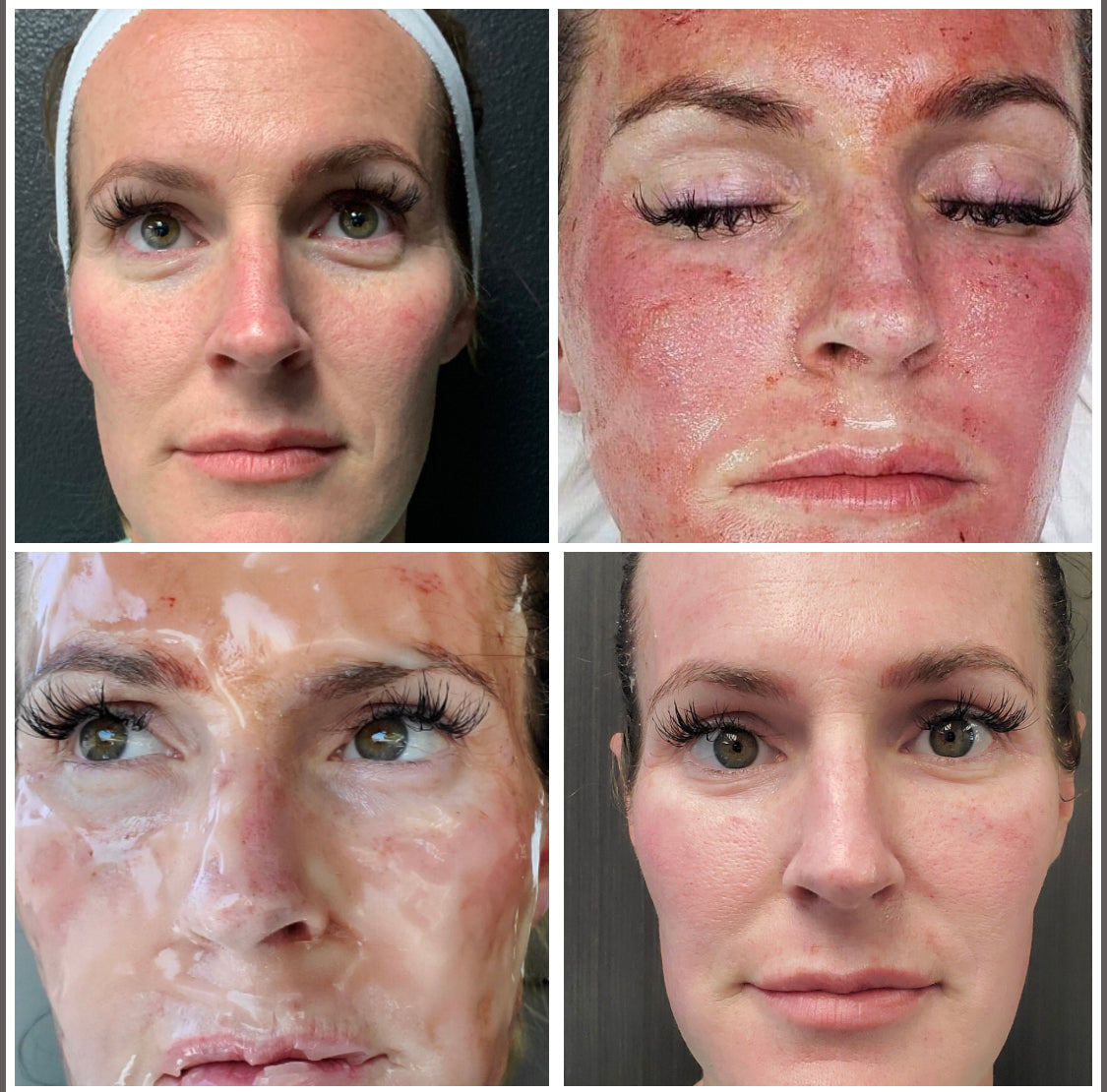 Microneedling + CO2 Lift (Carboxy Treatment)
