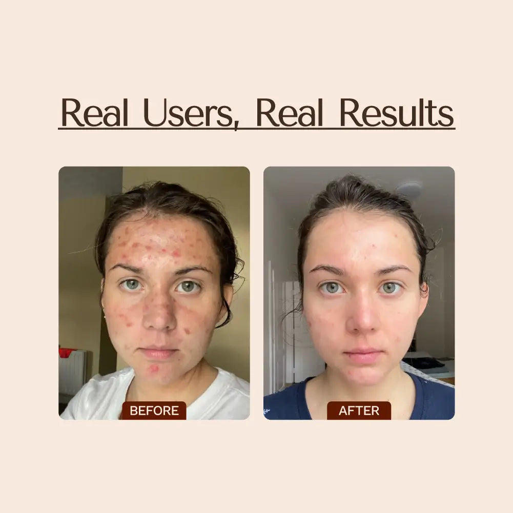 Shaant Spot Hero Pimple Gel