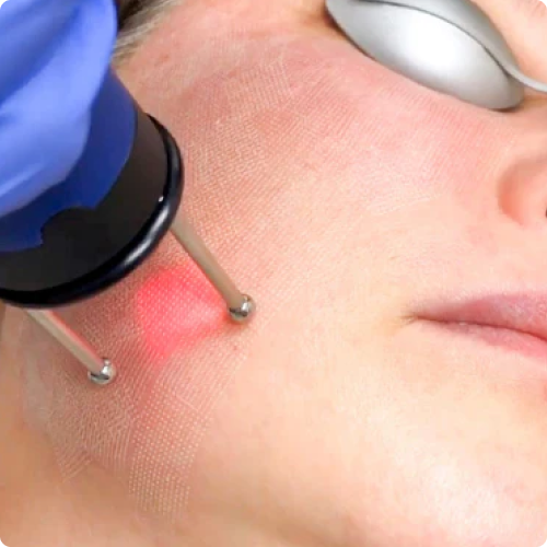 Erbium Fractional Resurfacing — Buy One, Get One (2 Treatments)