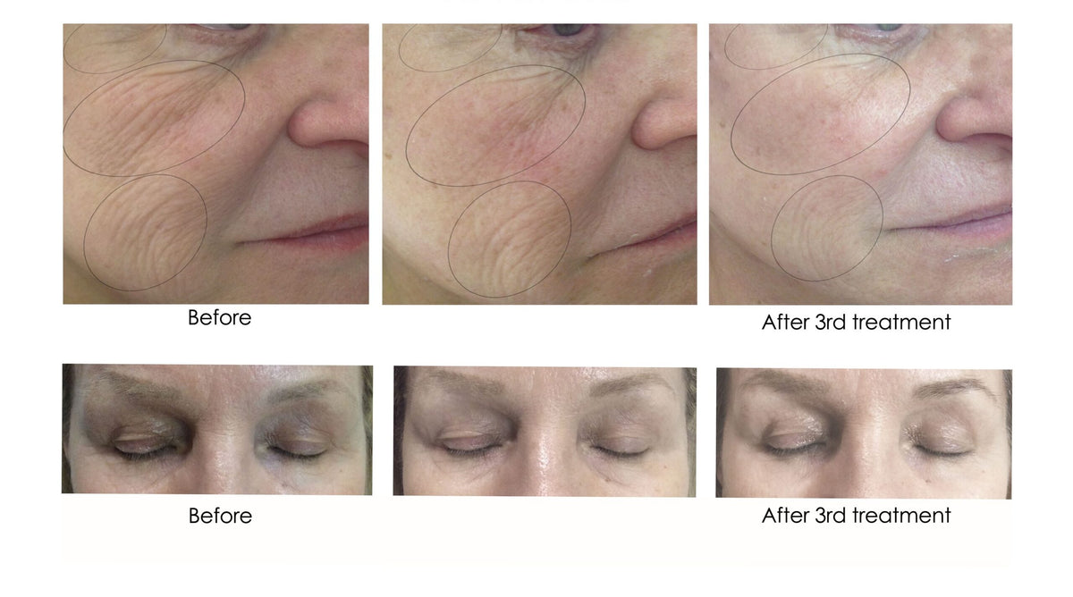 CO2 Lift Carboxy Treatment