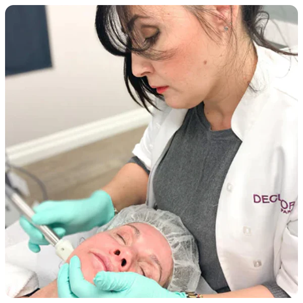 Fractora Face - RF Microneedling (Save 50%)