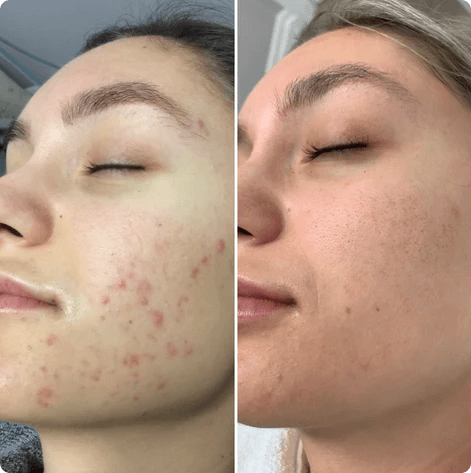 Yellow Laser Full-Face Scan — Buy One, Get One (2 Treatments)