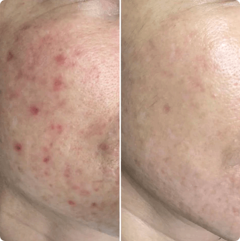 Yellow Laser Full-Face Scan — Buy One, Get One (2 Treatments)