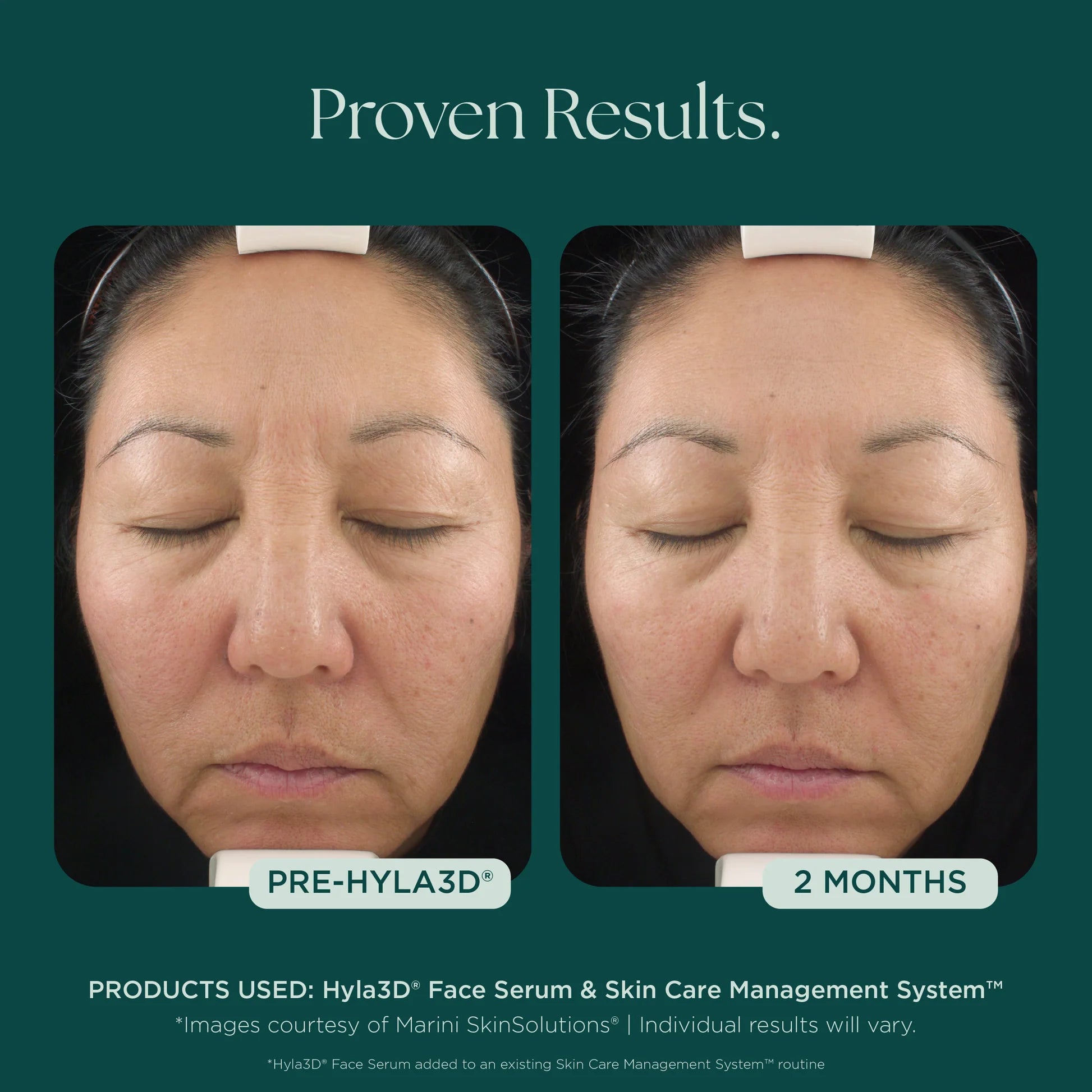 Hyla3D® Face Serum Hyaluronic Acid Complex