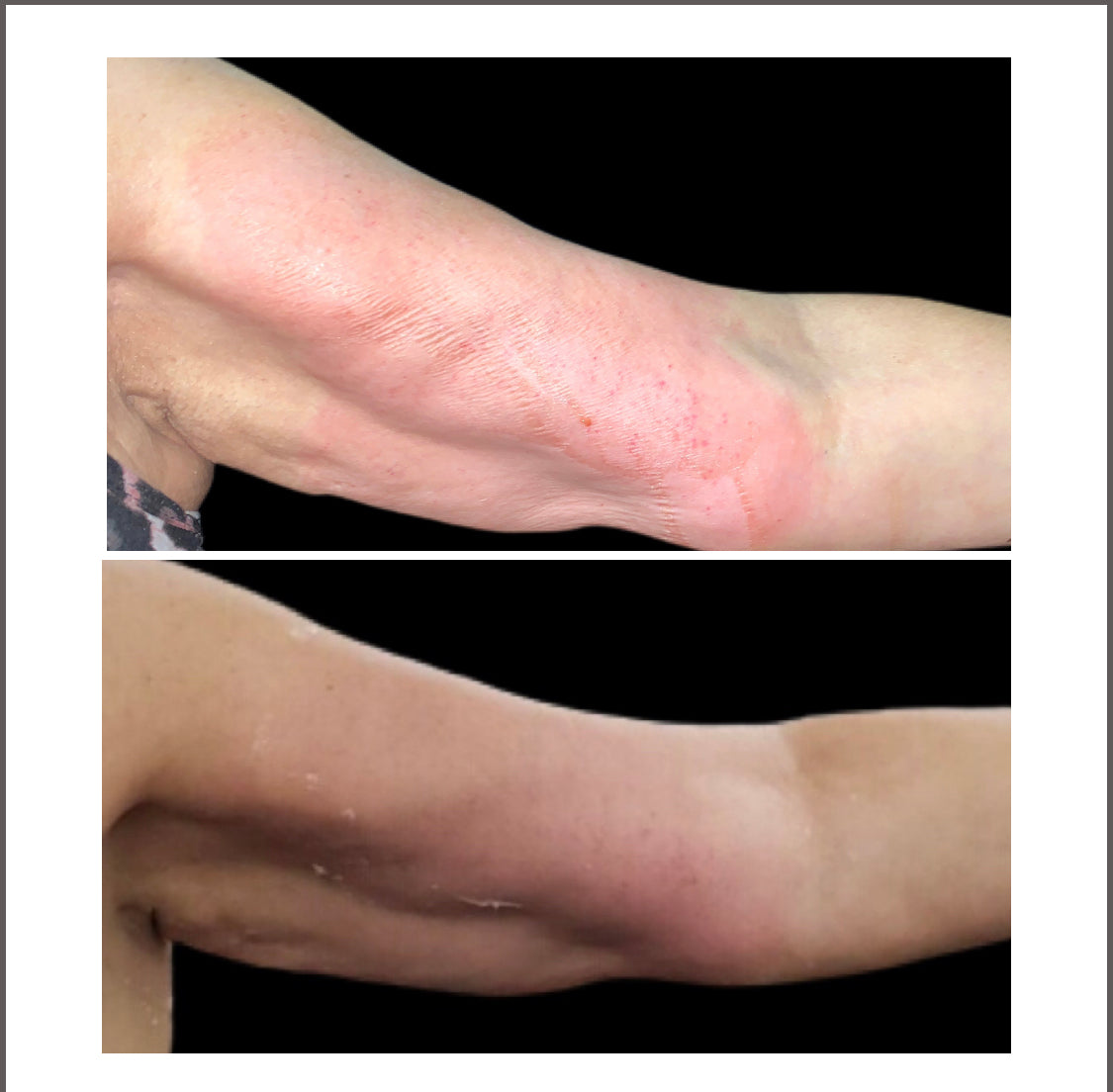 CO2 Lift Carboxy Treatment