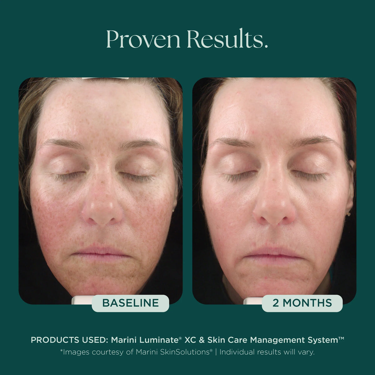 Marini Luminate® XC Face Lotion