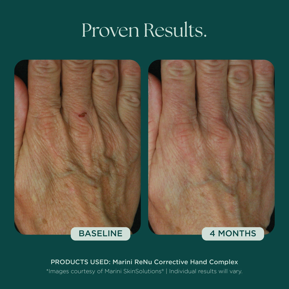 Marini ReNu Corrective Hand Complex