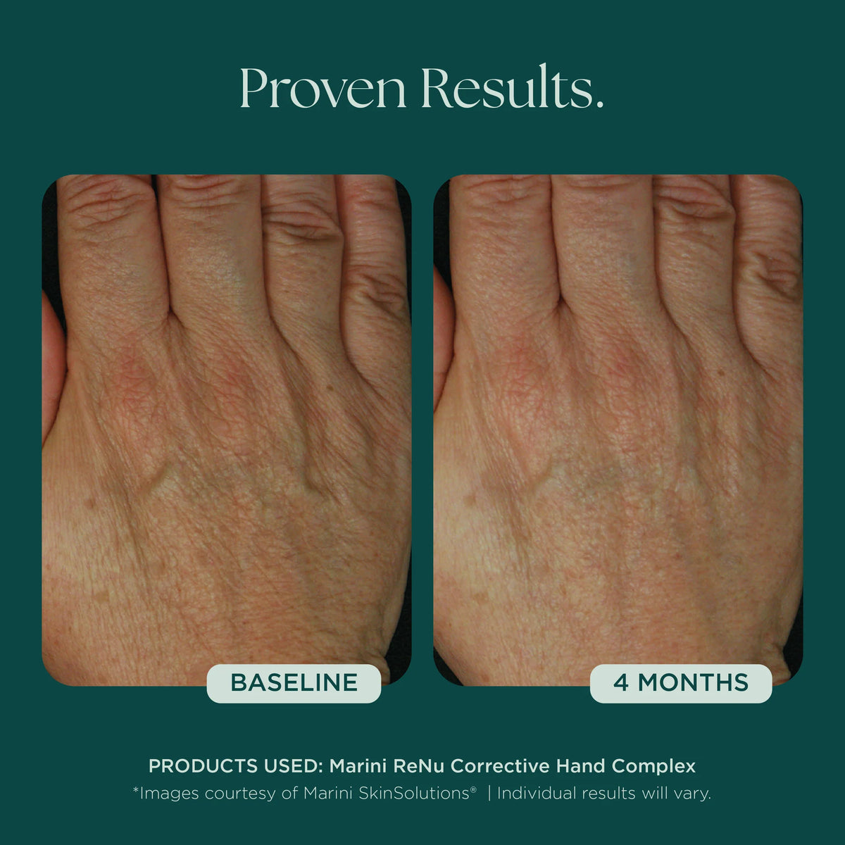 Marini ReNu Corrective Hand Complex