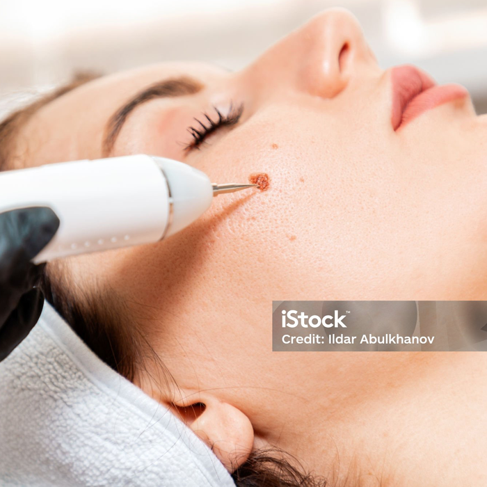 Skin Tag & Mole Removal (Quadrostar ProYellow 577nm)
