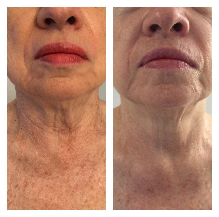 CO2 Lift Carboxy Treatment