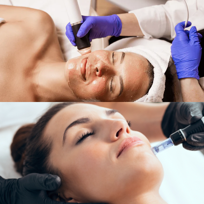 OxyGeneo and Microdermabrasion