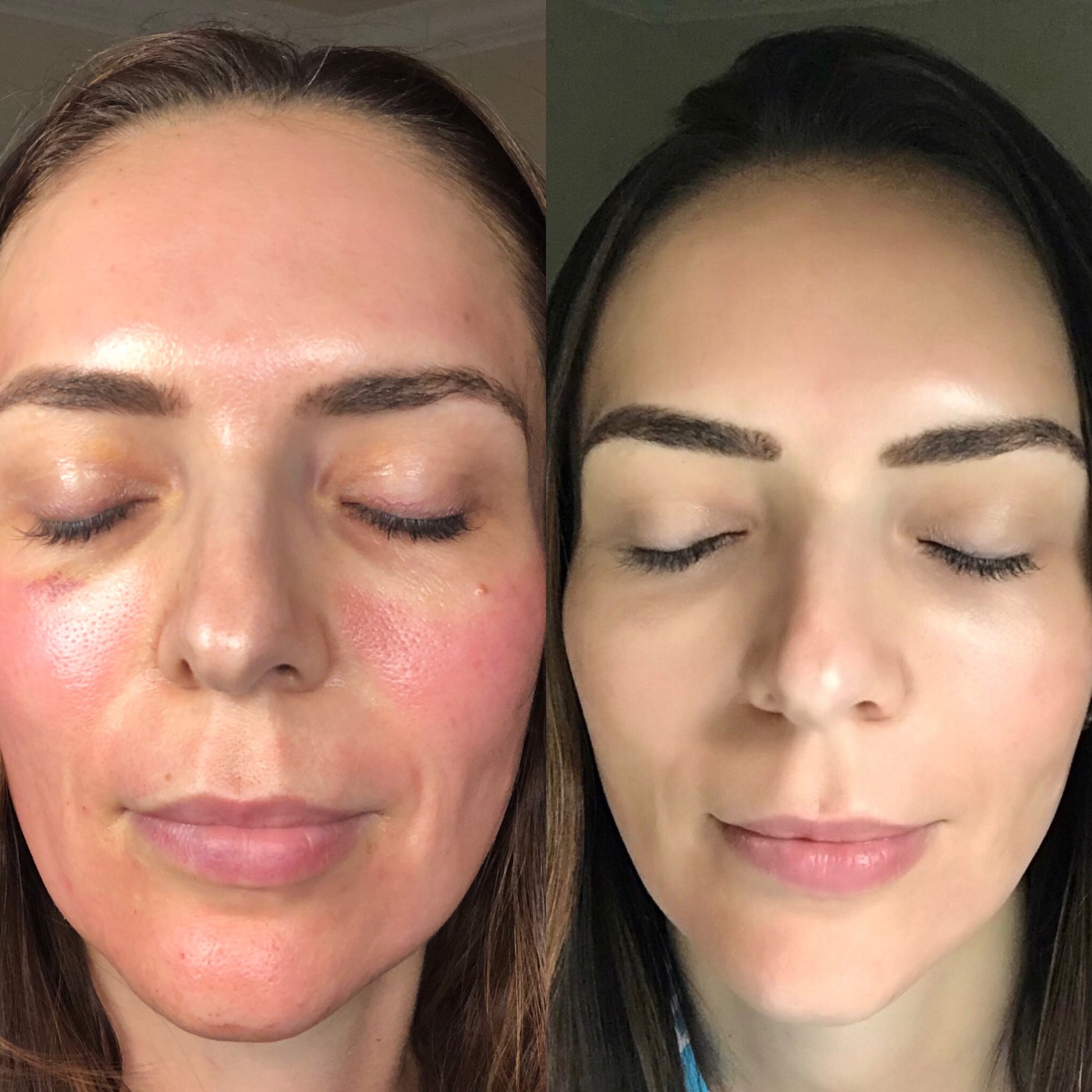 Microneedling + CO2 Lift (Carboxy Treatment)