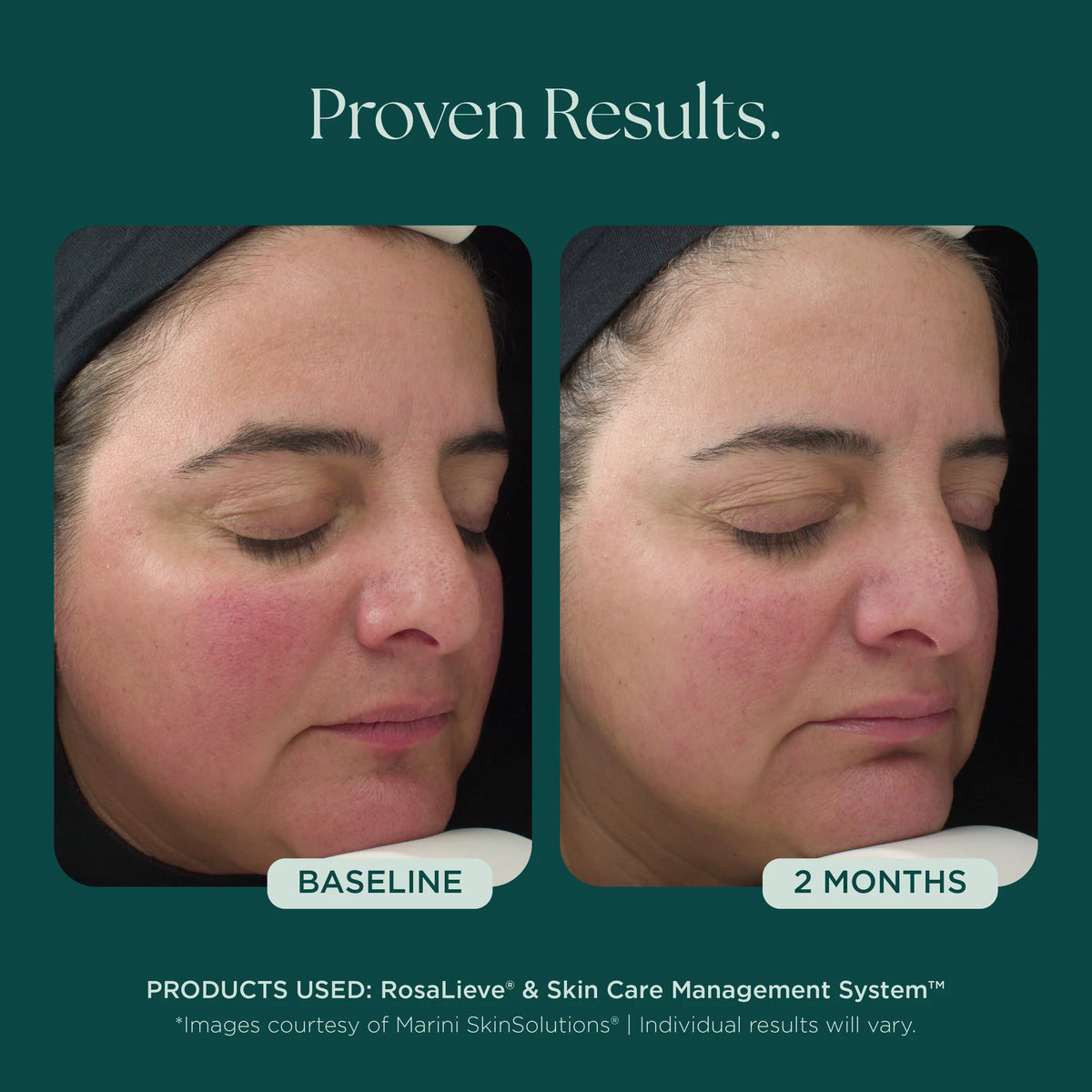 RosaLieve Redness Reducing Complex