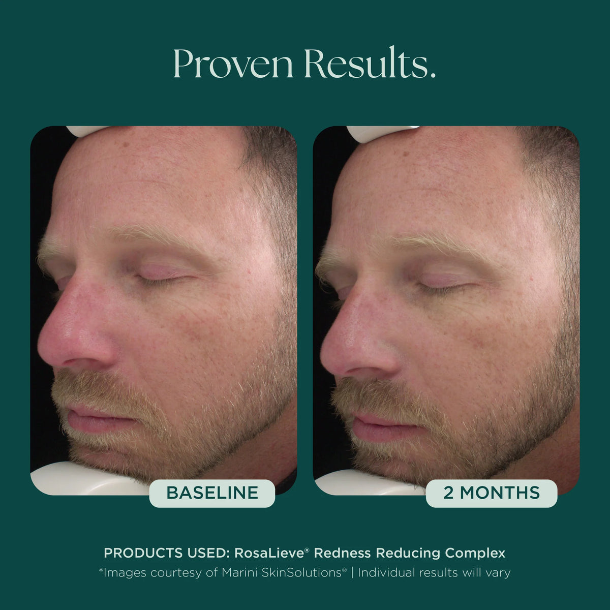 RosaLieve Redness Reducing Complex