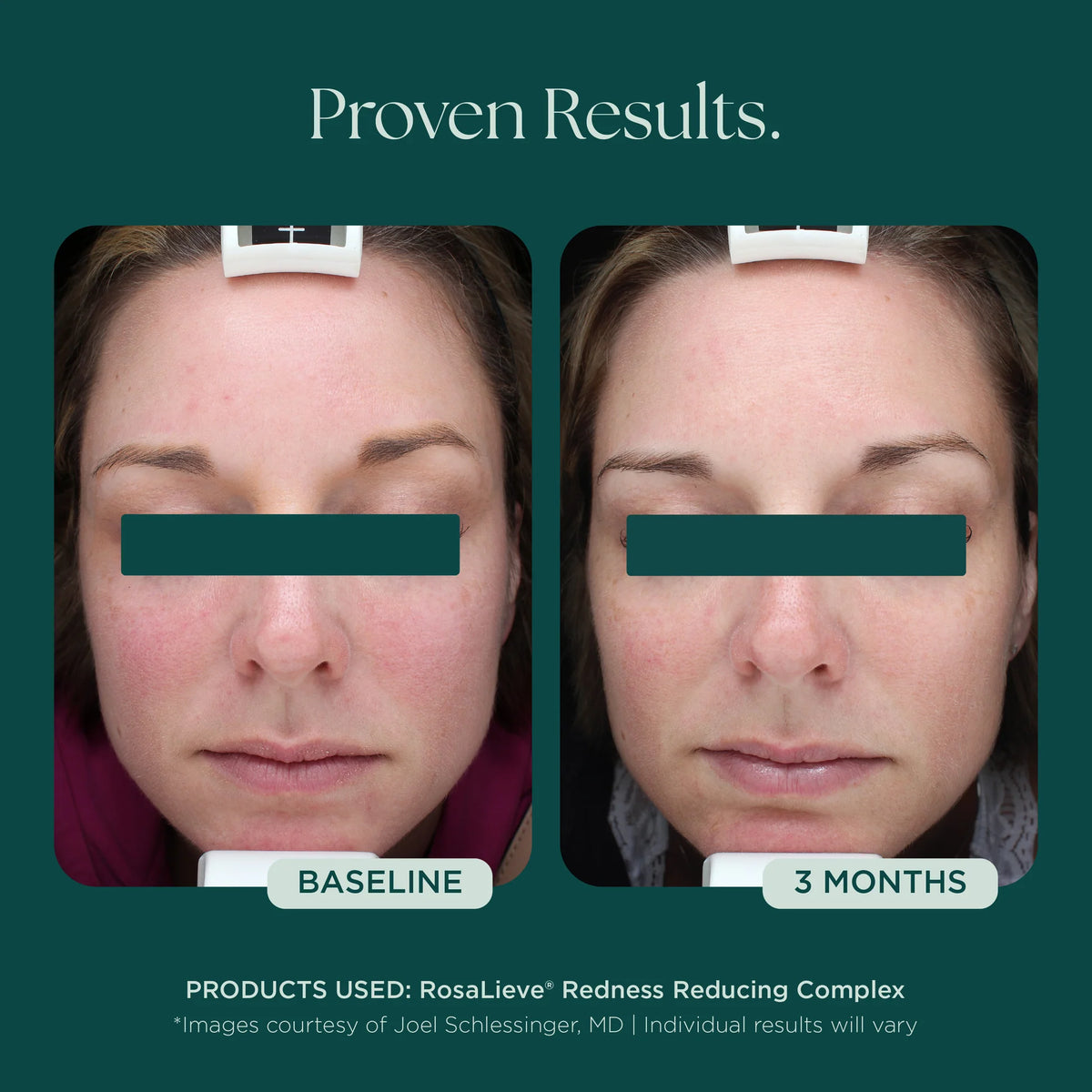 RosaLieve Redness Reducing Complex