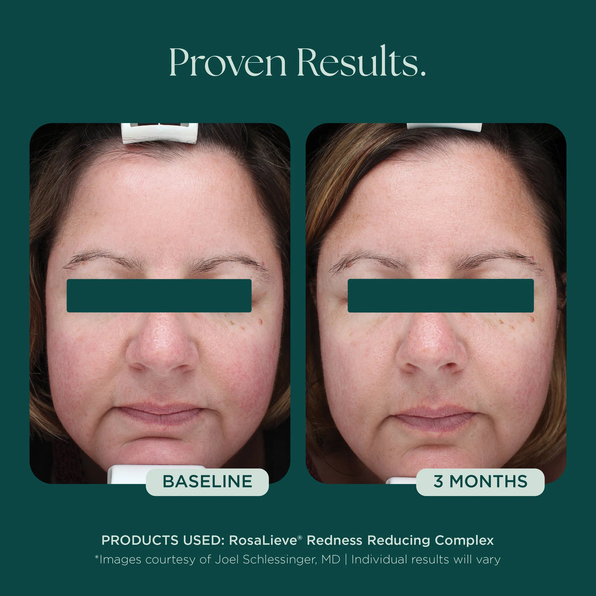 RosaLieve Redness Reducing Complex