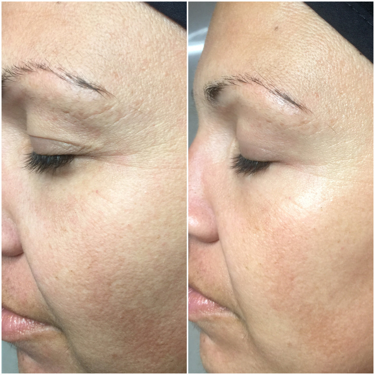 CO2 Lift Carboxy Treatment