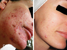 Load image into Gallery viewer, DMK Oxygen Facial
