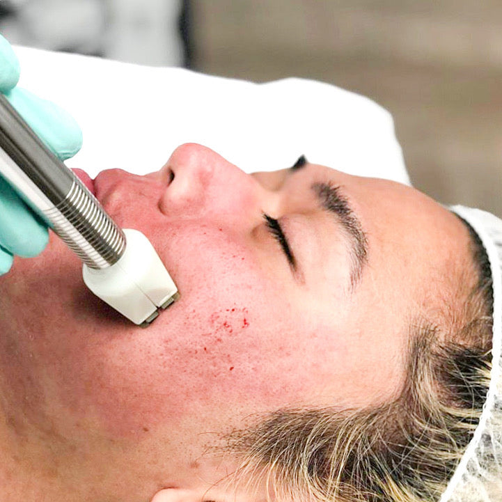 Fractora RF Microneedling — Buy One, Get One (2 Treatments)