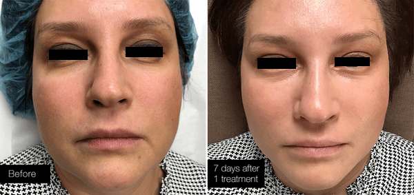 Erbium Lunch Time Laser Peel (Save 50%)