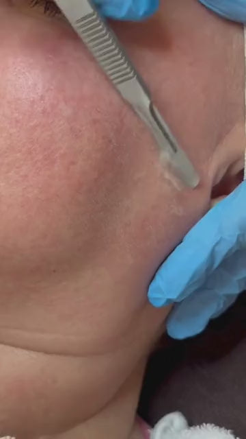 [BOGO] - Dermaplaning with Chemical Peel