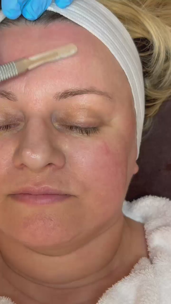 [BOGO] - Dermaplaning with Chemical Peel