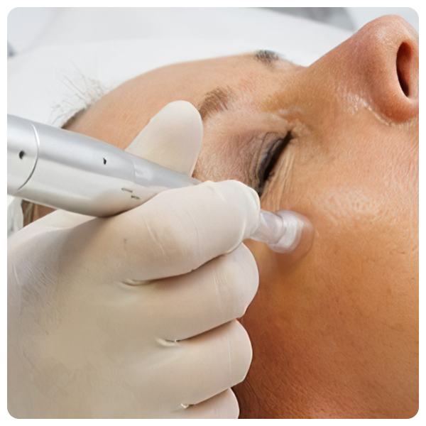 Microneedling + CO2 Lift (Carboxy Treatment)